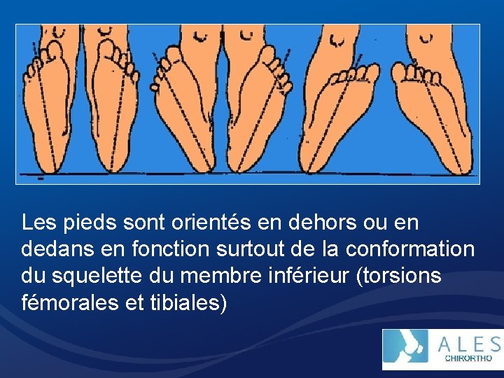 Les pieds sont orientés en dehors ou en dedans en fonction surtout de la