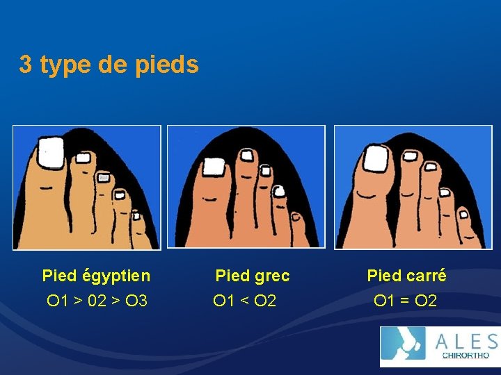 3 type de pieds Pied égyptien O 1 > 02 > O 3 Pied