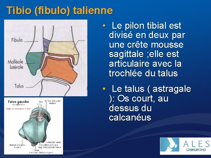 Tibio (fibulo) talienne • Le pilon tibial est divisé en deux par une crête