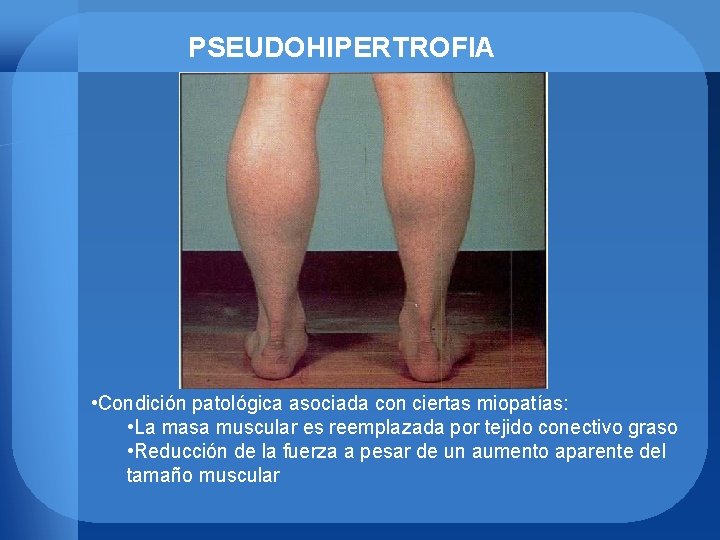 PSEUDOHIPERTROFIA • Condición patológica asociada con ciertas miopatías: • La masa muscular es reemplazada