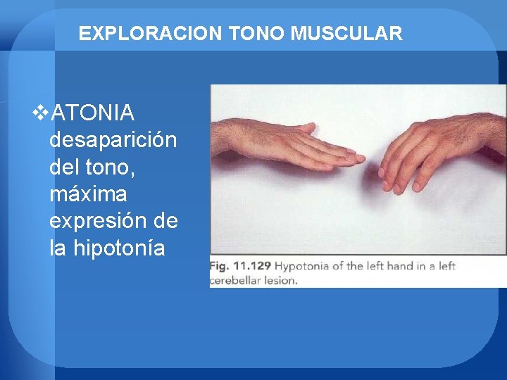 EXPLORACION TONO MUSCULAR v. ATONIA desaparición del tono, máxima expresión de la hipotonía 