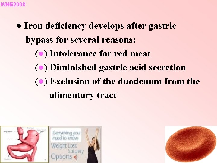 WHE 2008 ● Iron deficiency develops after gastric bypass for several reasons: (●) Intolerance