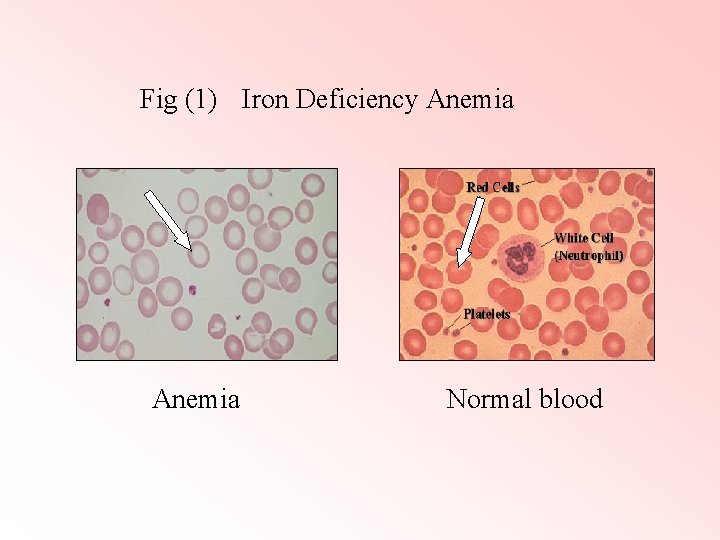 Fig (1) Iron Deficiency Anemia Normal blood 