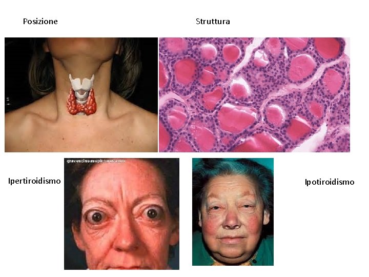 Posizione Ipertiroidismo Struttura Ipotiroidismo 