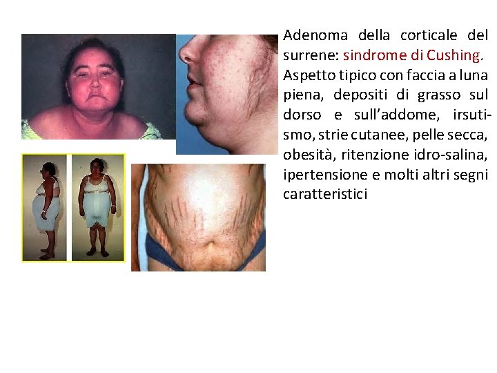 Adenoma della corticale del surrene: sindrome di Cushing. Aspetto tipico con faccia a luna