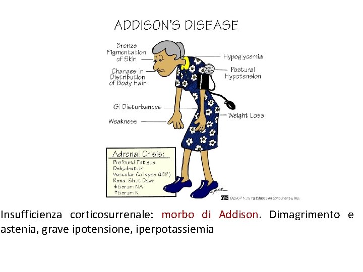Insufficienza corticosurrenale: morbo di Addison. Dimagrimento e astenia, grave ipotensione, iperpotassiemia 