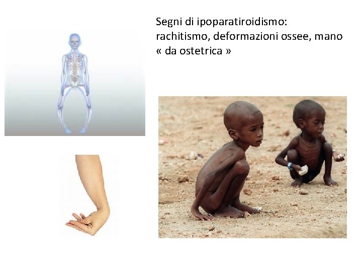 Segni di ipoparatiroidismo: rachitismo, deformazioni ossee, mano « da ostetrica » 