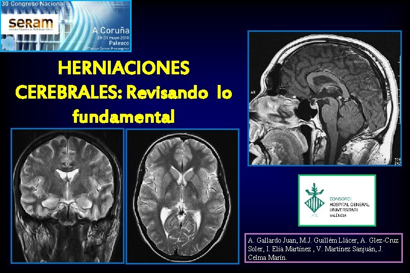 HERNIACIONES CEREBRALES: Revisando lo fundamental A. Gallardo Juan, M. J. Guillém Llácer, A. Glez-Cruz