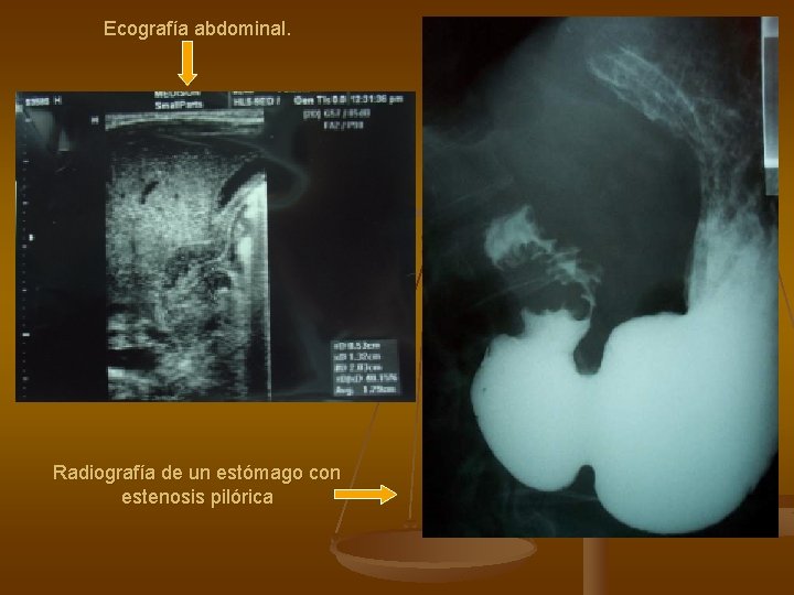 Ecografía abdominal. Radiografía de un estómago con estenosis pilórica 