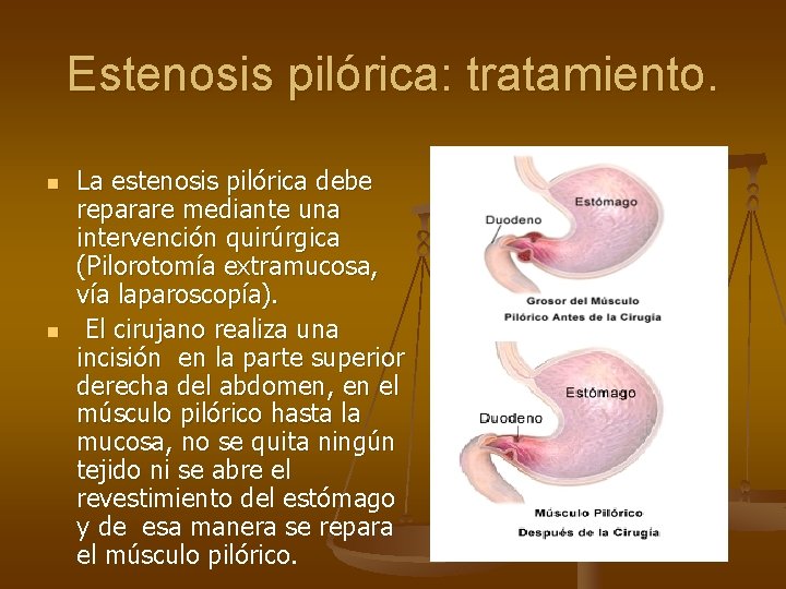 Estenosis pilórica: tratamiento. n n La estenosis pilórica debe reparare mediante una intervención quirúrgica