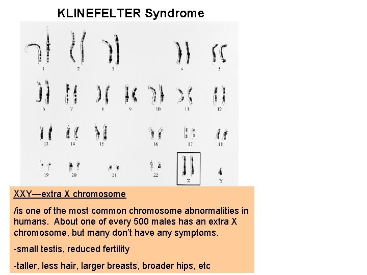 KLINEFELTER Syndrome XXY---extra X chromosome /is one of the most common chromosome abnormalities in
