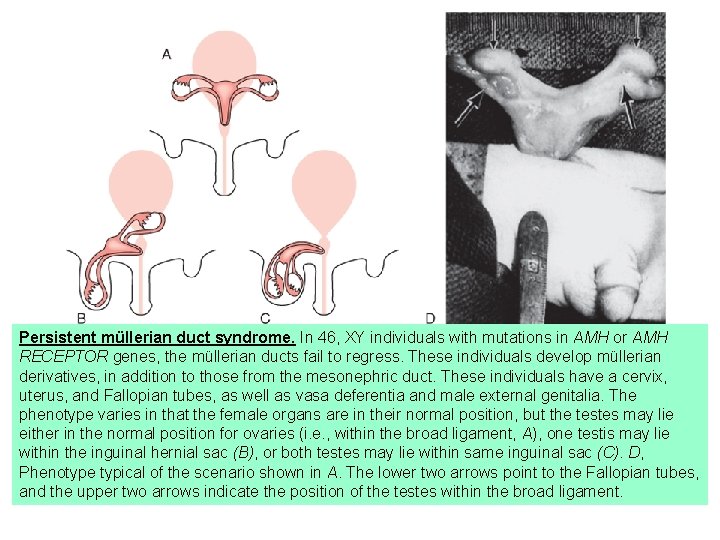 Persistent müllerian duct syndrome. In 46, XY individuals with mutations in AMH or AMH
