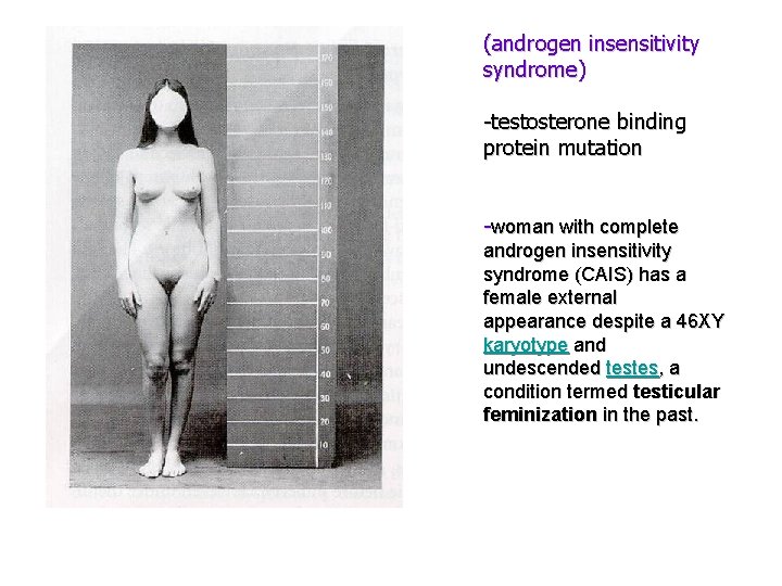 (androgen insensitivity syndrome) -testosterone binding protein mutation -woman with complete androgen insensitivity syndrome (CAIS)
