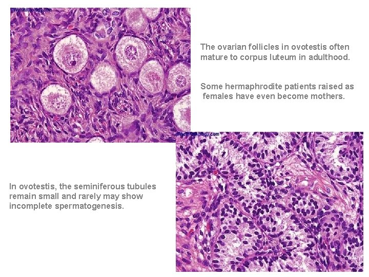 The ovarian follicles in ovotestis often mature to corpus luteum in adulthood. Some hermaphrodite