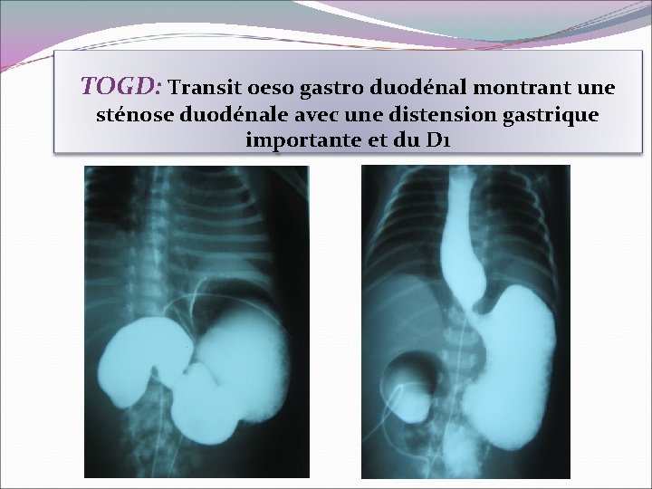TOGD: Transit oeso gastro duodénal montrant une sténose duodénale avec une distension gastrique importante