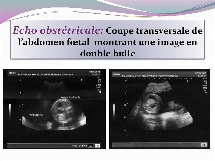 Echo obstétricale: Coupe transversale de l’abdomen fœtal montrant une image en double bulle Image