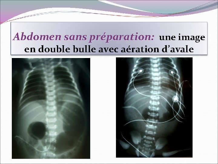 Abdomen sans préparation: une image en double bulle avec aération d’avale Image en double