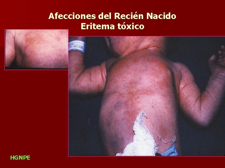 Afecciones del Recién Nacido Eritema tóxico HGNPE 