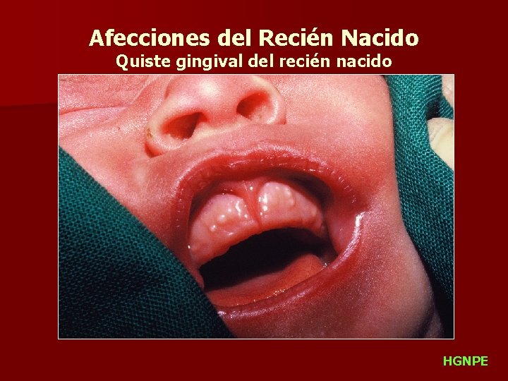 Afecciones del Recién Nacido Quiste gingival del recién nacido HGNPE 