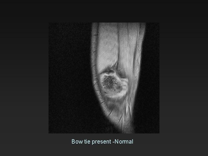 Bow tie present -Normal 
