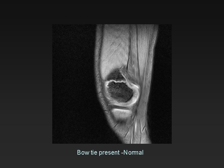 Bow tie present -Normal 
