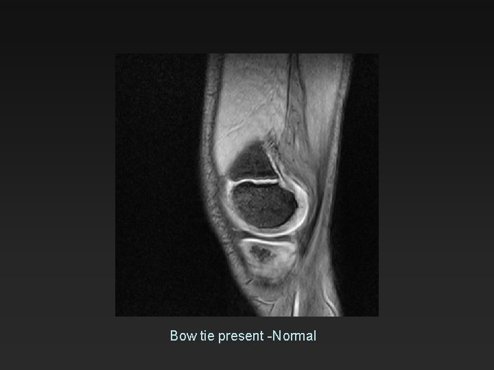 Bow tie present -Normal 