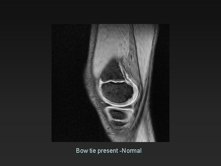 Bow tie present -Normal 