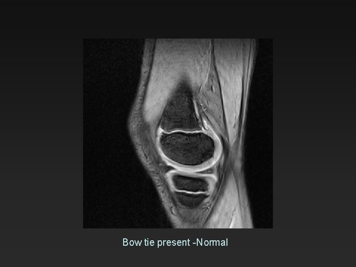 Bow tie present -Normal 