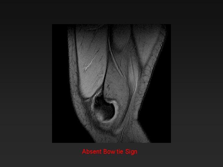 Absent Bow tie Sign 