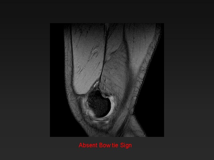 Absent Bow tie Sign 