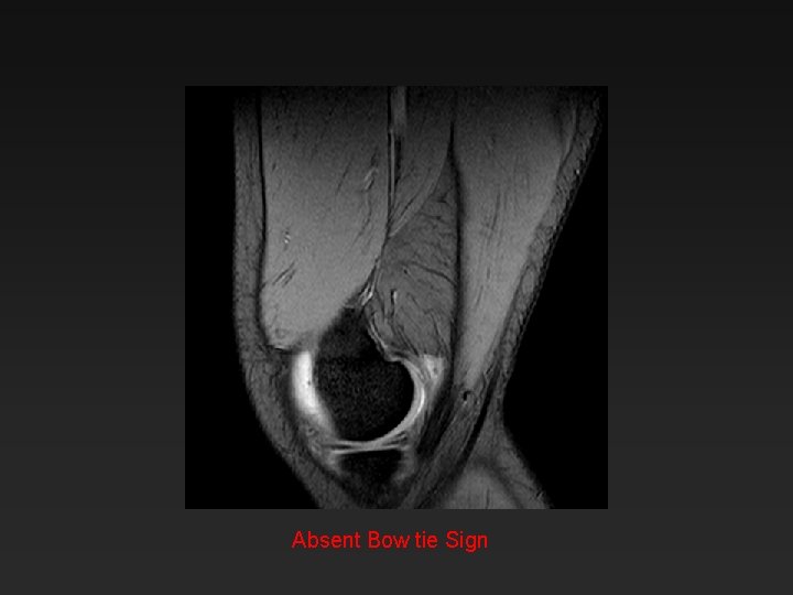 Absent Bow tie Sign 