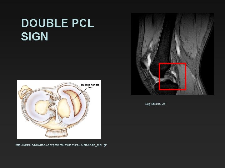 DOUBLE PCL SIGN Sag MEDIC 2 d http: //www. leadingmd. com/patient. Ed/assets/buckethandle_tear. gif 