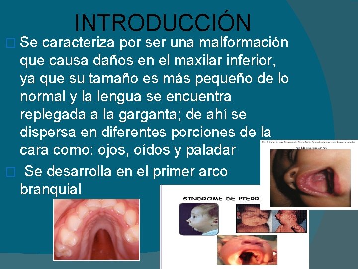 INTRODUCCIÓN � Se caracteriza por ser una malformación que causa daños en el maxilar