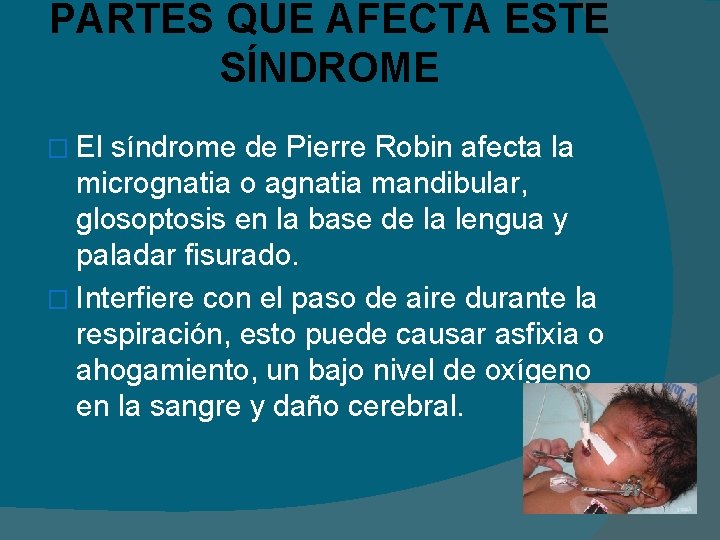 PARTES QUE AFECTA ESTE SÍNDROME � El síndrome de Pierre Robin afecta la micrognatia