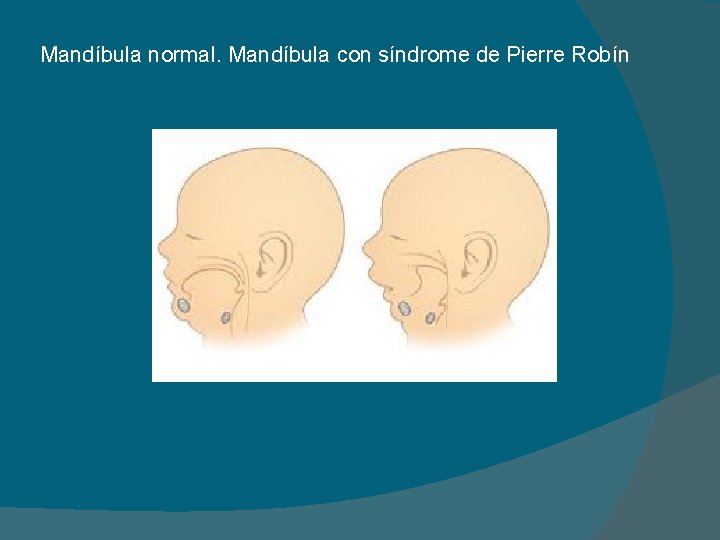 Mandíbula normal. Mandíbula con síndrome de Pierre Robín 