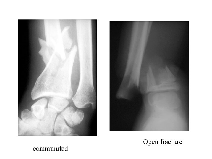 communited Open fracture 