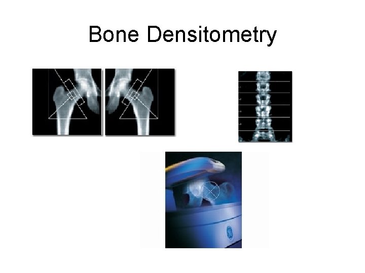 Bone Densitometry 