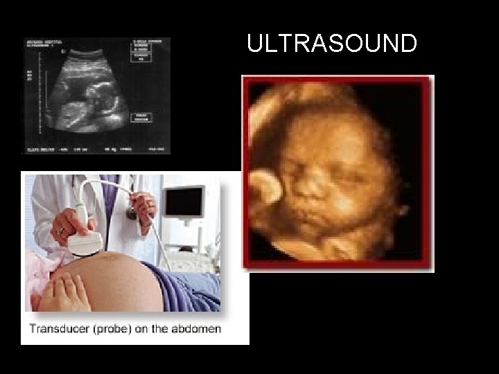 ULTRASOUND uses a technique similar to Navy SONAR to produce diagnostic images. 