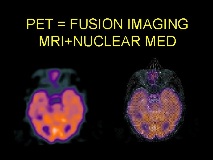 PET = FUSION IMAGING MRI+NUCLEAR MED 