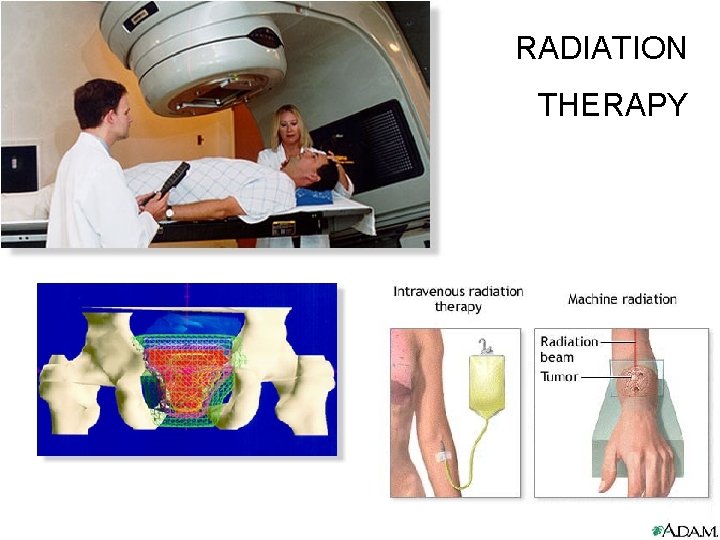 RADIATION THERAPY 