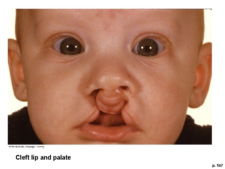 Cleft lip and palate p. 167 