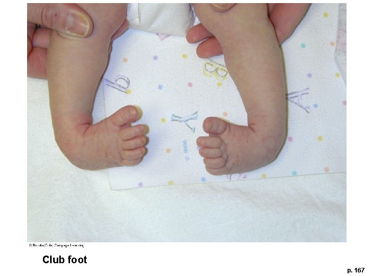 Club foot p. 167 