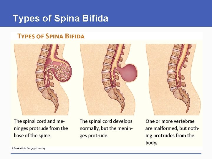 Types of Spina Bifida 