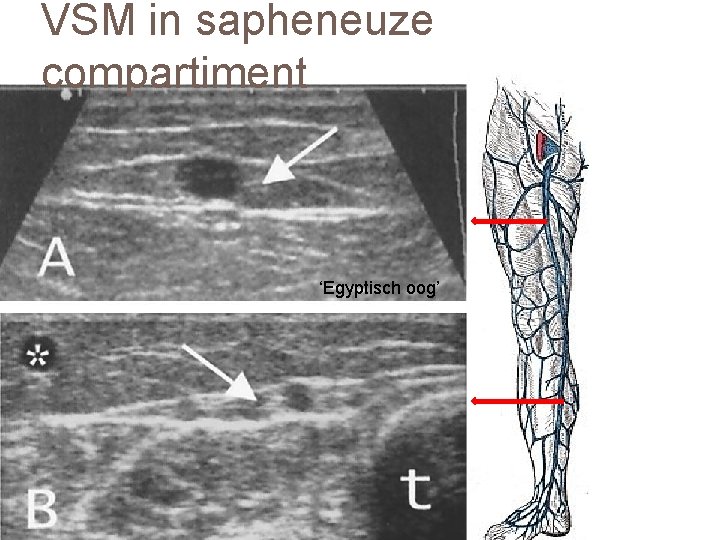 VSM in sapheneuze compartiment ‘Egyptisch oog’ 