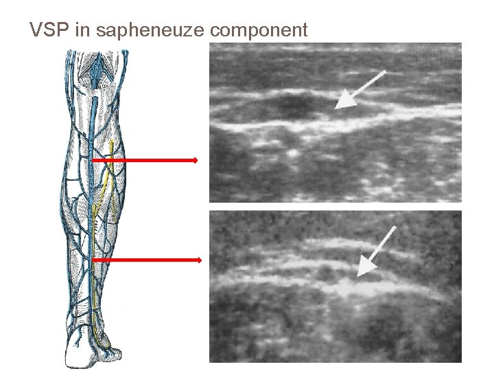 VSP in sapheneuze component 