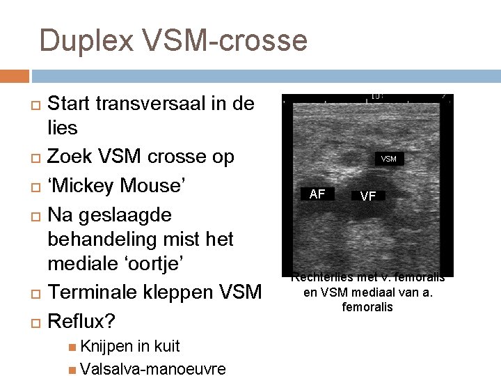 Duplex VSM-crosse Start transversaal in de lies Zoek VSM crosse op ‘Mickey Mouse’ Na