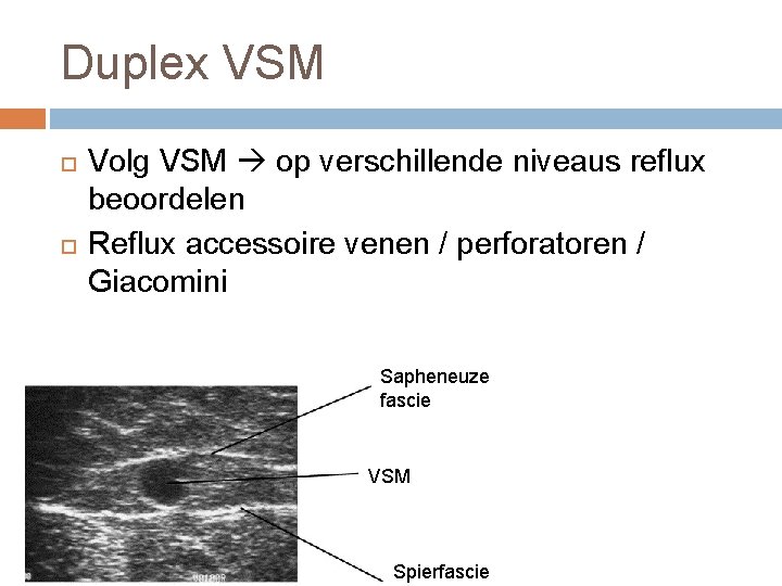 Duplex VSM Volg VSM op verschillende niveaus reflux beoordelen Reflux accessoire venen / perforatoren