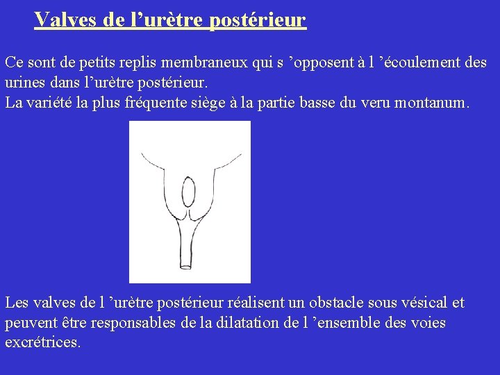 Valves de l’urètre postérieur Ce sont de petits replis membraneux qui s ’opposent Valves de l’urètre postérieur Ce sont de petits replis membraneux qui s ’opposent