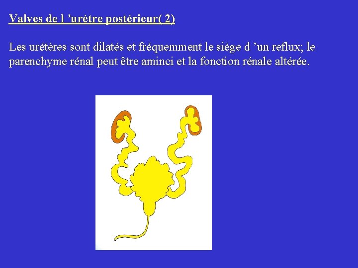 Valves de l ’urètre postérieur( 2) Les urétères sont dilatés et fréquemment le siège Valves de l ’urètre postérieur( 2) Les urétères sont dilatés et fréquemment le siège