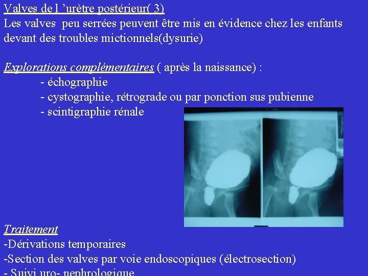 Valves de l ’urètre postérieur( 3) Les valves peu serrées peuvent être mis en Valves de l ’urètre postérieur( 3) Les valves peu serrées peuvent être mis en